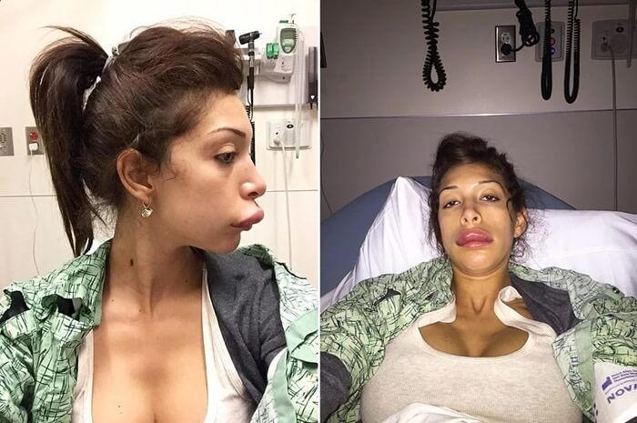 Farrah Abraham après une chirurgie plastique ratée