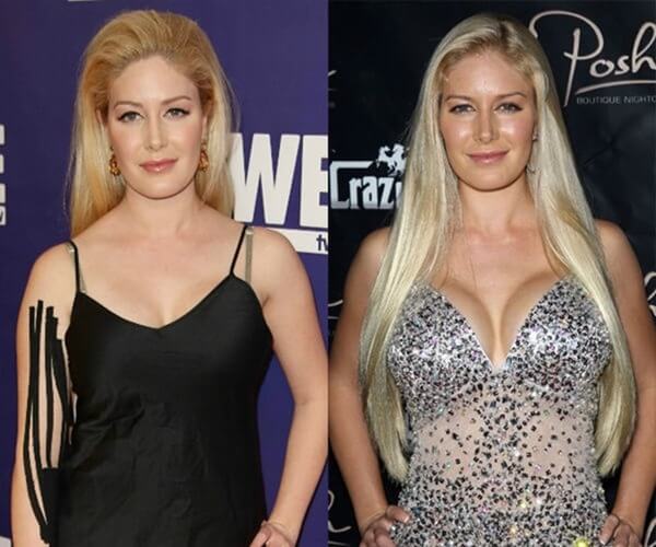 Photo Heidi Montag avant et après la chirurgie plastique