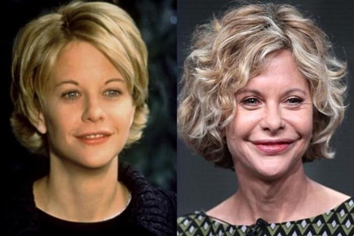 Photo de Meg Ryan après une chirurgie plastique