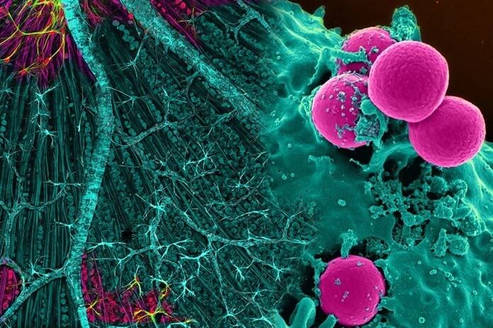 Cellules cancéreuses au microscope