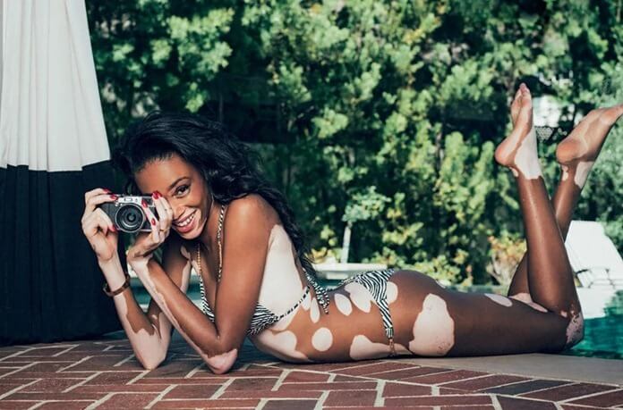 Vitiligo Winnie Harlow