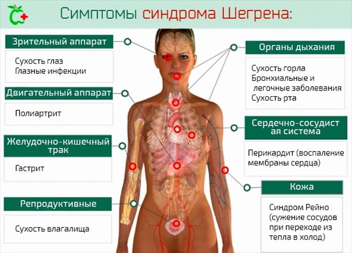 le syndrome de Sjogren