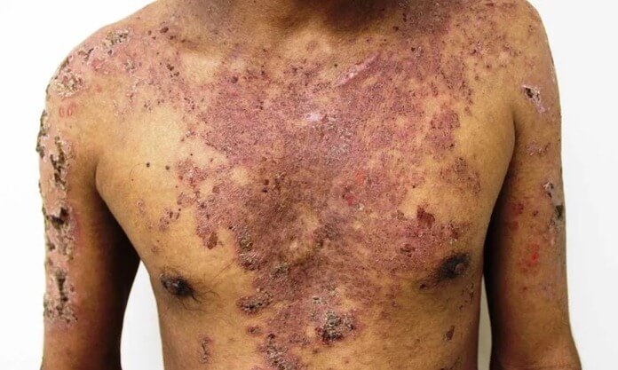 Pemphigus paranéoplasique