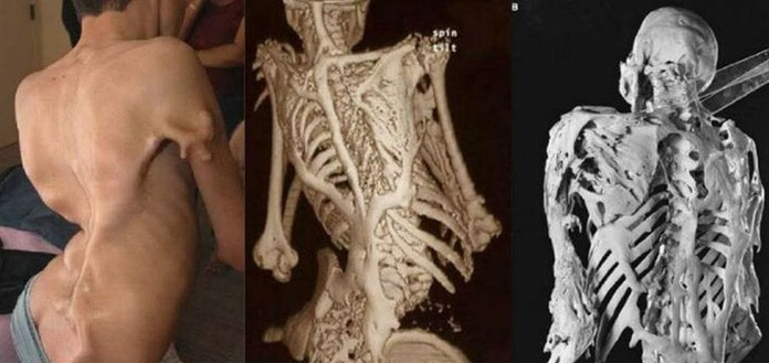 Fibrodysplasie ossifiante progressive